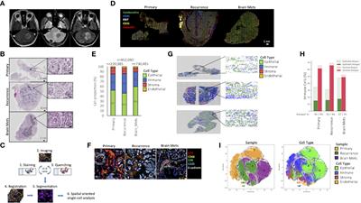 Single-Cell Proteomics Analysis of Recurrent Low-Grade Serous Ovarian Carcinoma and Associated Brain Metastases